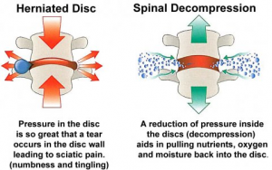 disc herniation